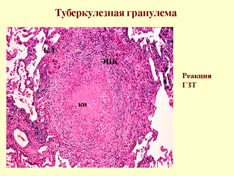 Туберкулезная гранулема кн ЭПК КЛ Реакция  ГЗТ